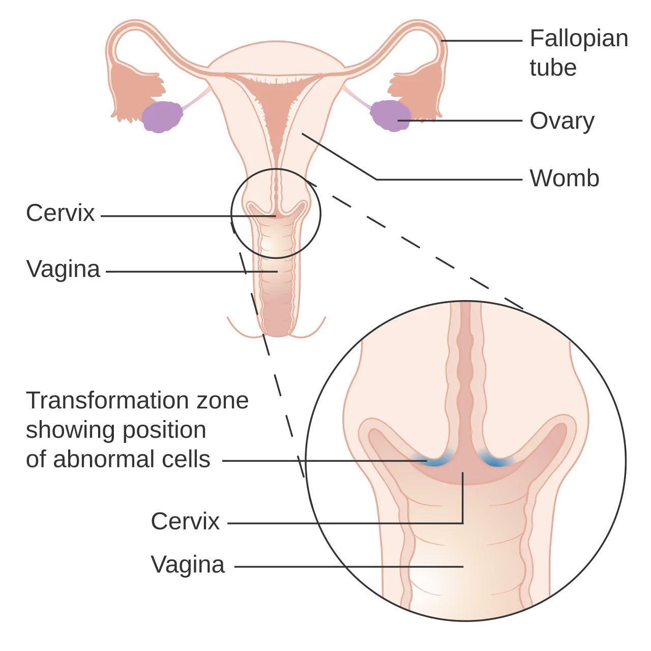 แผนภาพมดลูก ปากมดลูก และช่องคลอด ขยายให้เห็นบริเวณ transformation zone ของปากมดลูกและตำแหน่งของเซลล์ผิดปกติ